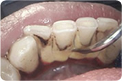 Dentalna preventiva
